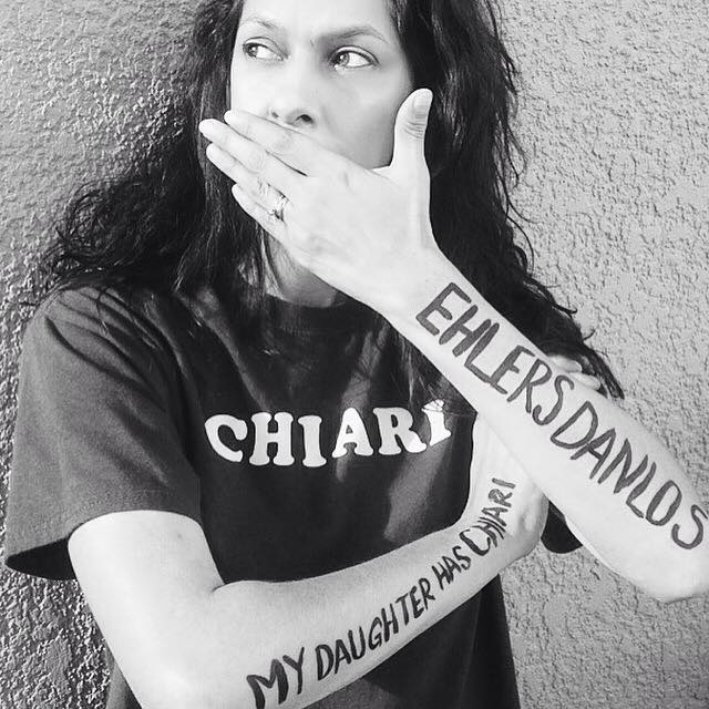 The Chiari Malformation Ehlers-Danlos Connection